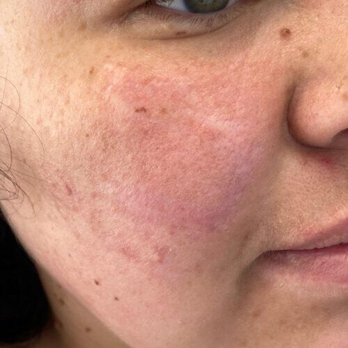 Scar Treatment Before & After Image