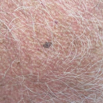 Close-up of skin with light hair and mole.