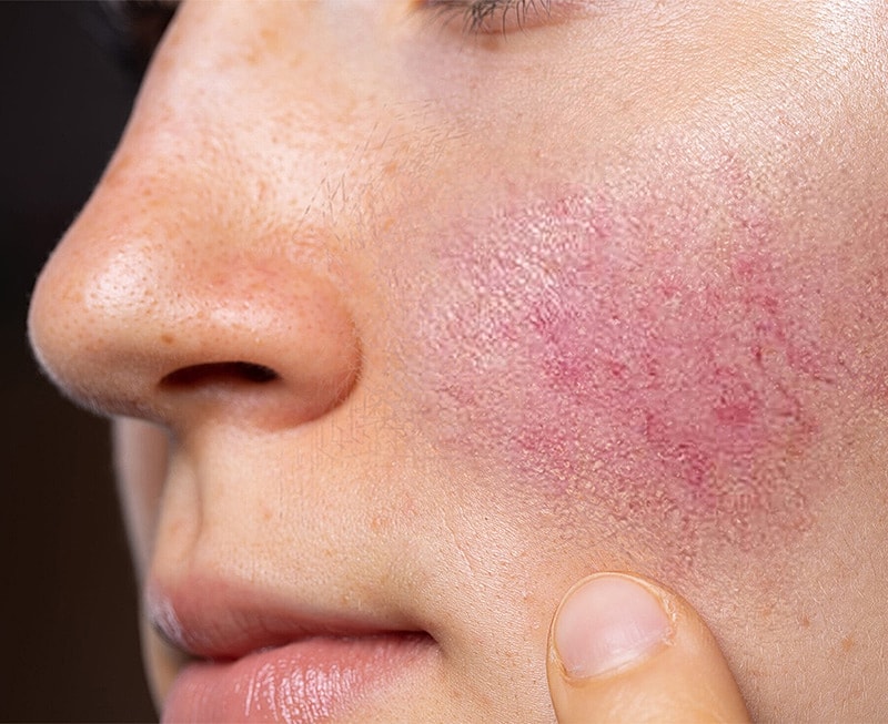 Close-up of skin with redness and irritation