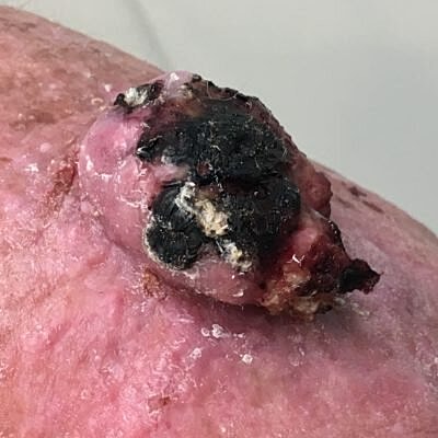 Skin abnormality with darkened scab-like growth.
