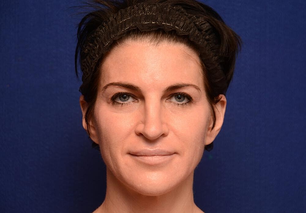 Xeomin Before & After