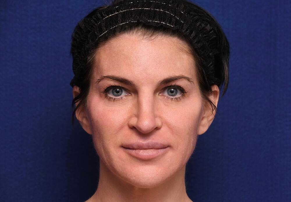 Xeomin Before & After