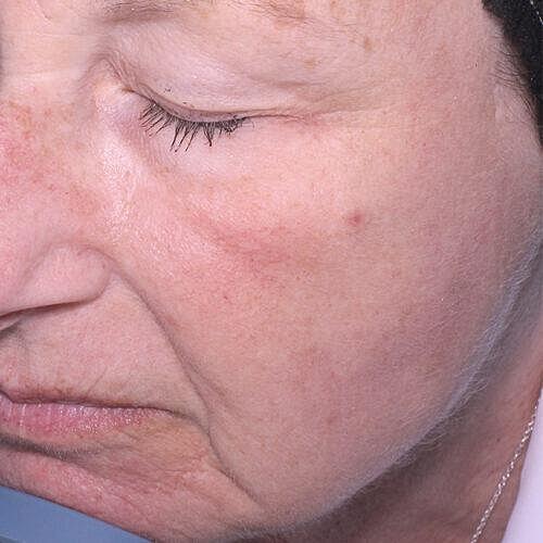 Halo Hybrid Fractional Laser Before & After