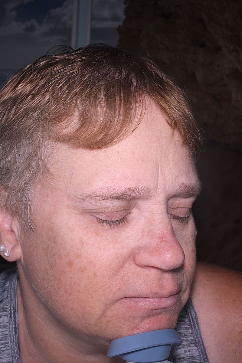 Halo Hybrid Fractional Laser Before & After