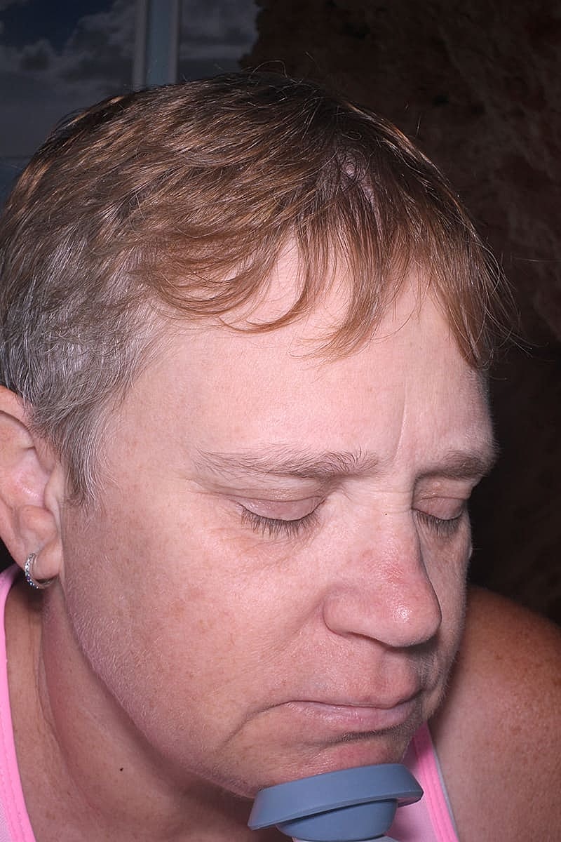 Halo Hybrid Fractional Laser Before & After