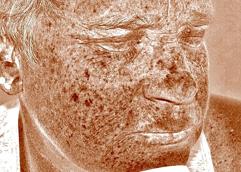 Halo Hybrid Fractional Laser Before & After