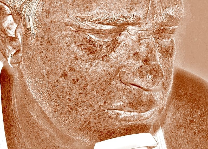 Halo Hybrid Fractional Laser Before & After