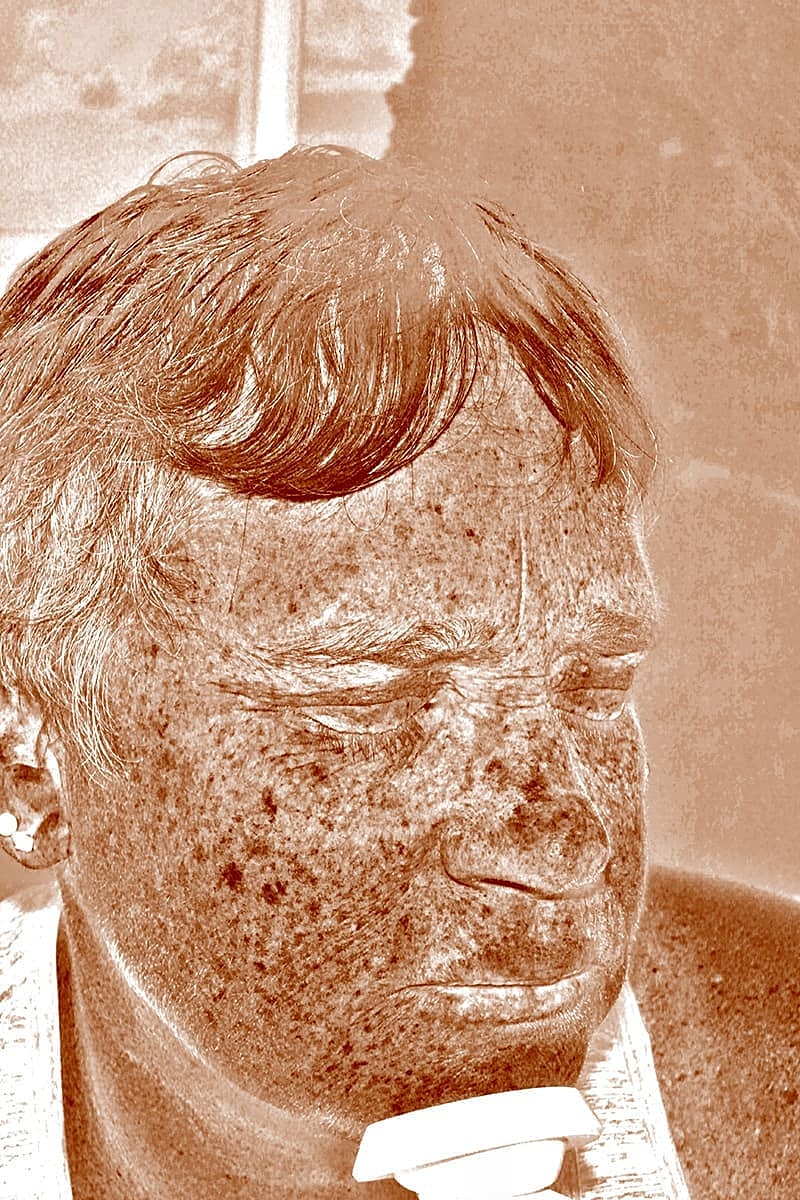 Halo Hybrid Fractional Laser Before & After