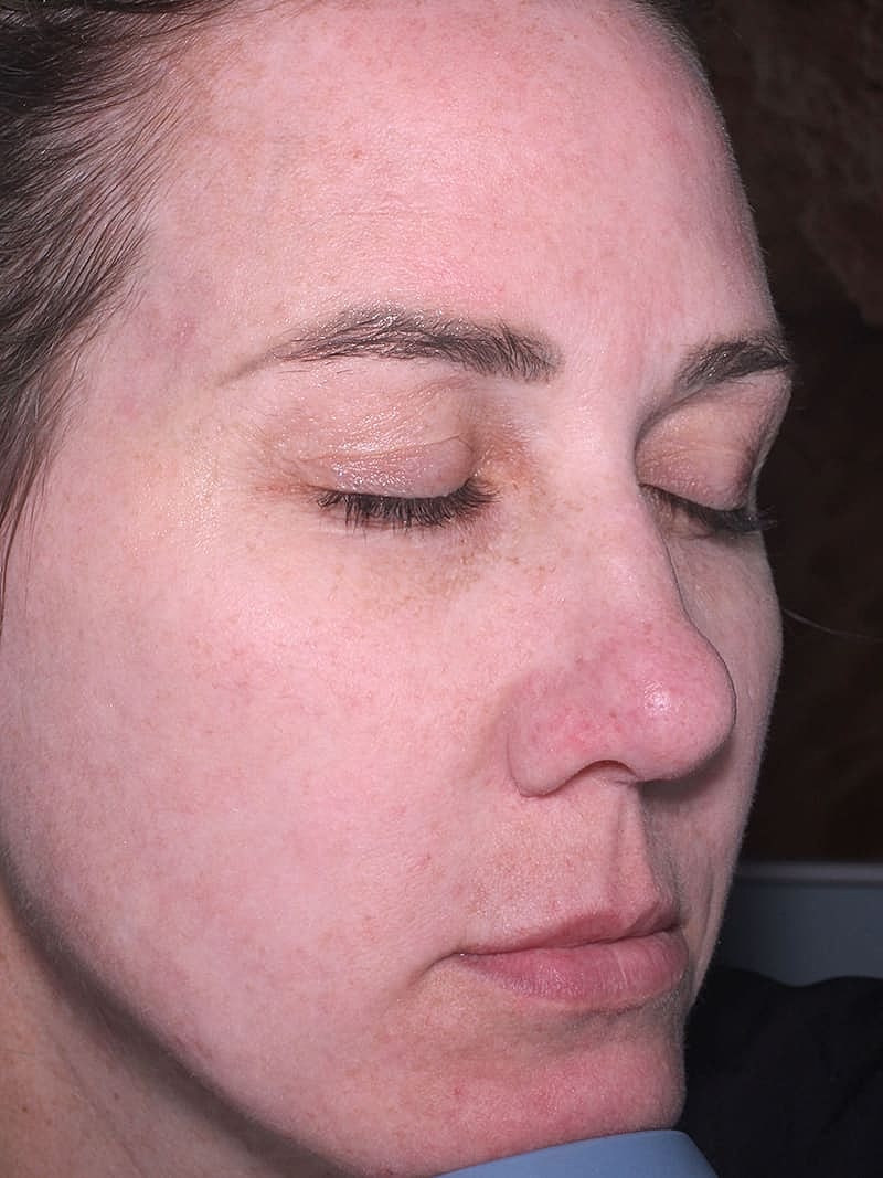 Halo Hybrid Fractional Laser Before & After