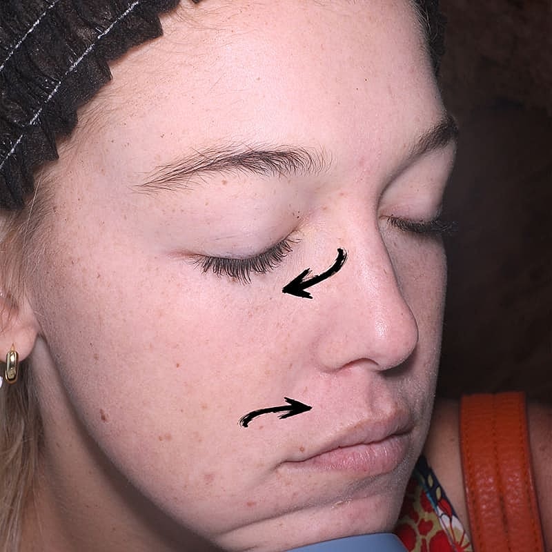 Halo Hybrid Fractional Laser Before & After