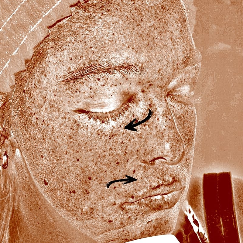 Halo Hybrid Fractional Laser Before & After