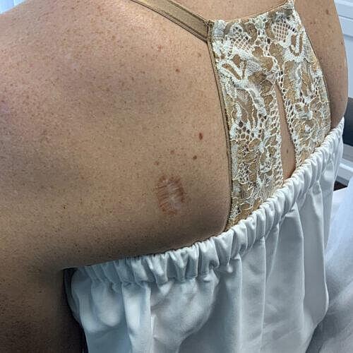 Scar Therapy Before & After