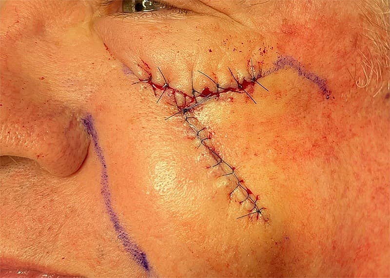 Scar Therapy Before & After