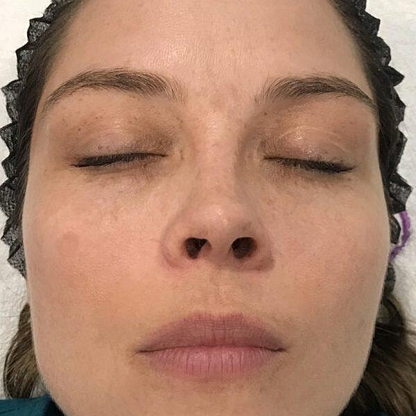 Broadband Light Bbl Before & After