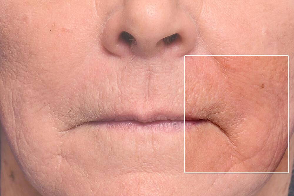 Profractional Laser Before & After