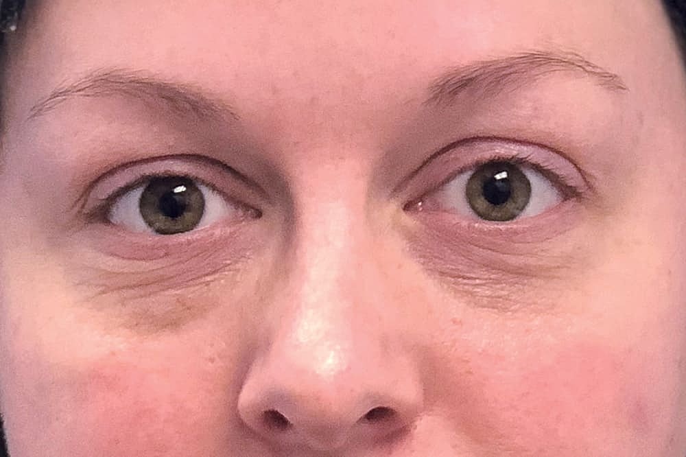 Profractional Laser Before & After