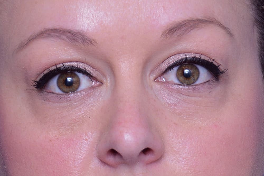 Profractional Laser Before & After