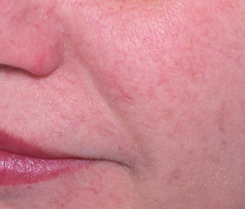 Clear V Laser Before & After