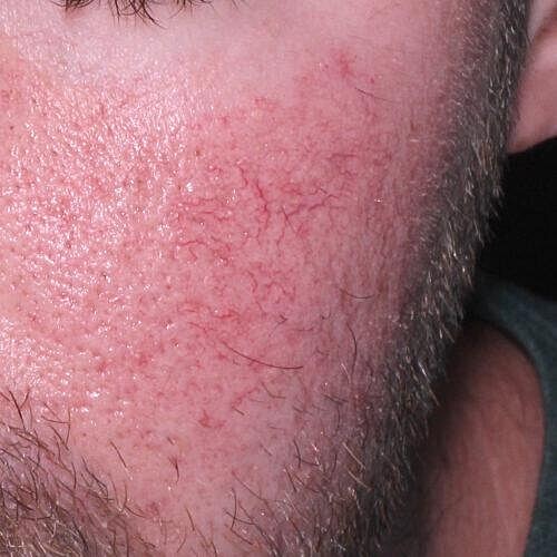 Clear V Laser Before & After