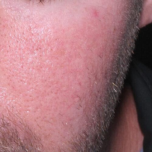 Clear V Laser Before & After