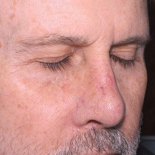 Clear V Laser Before & After