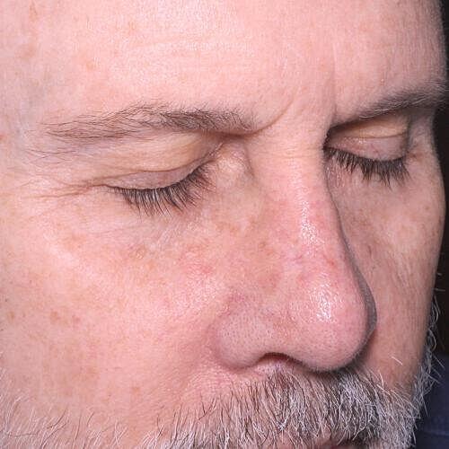 Clear V Laser Before & After