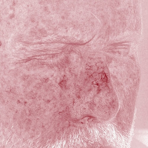 Clear V Laser Before & After