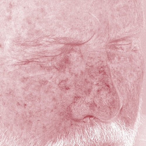 Clear V Laser Before & After