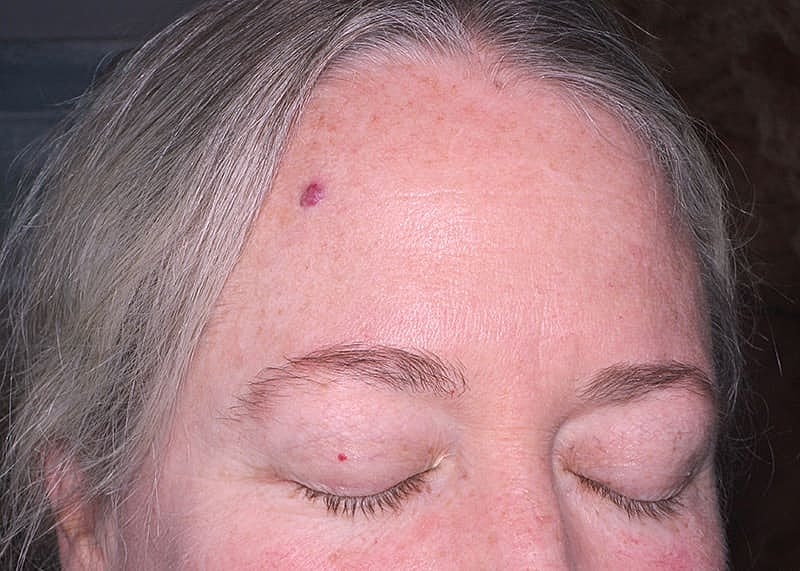 Clear V Laser Before & After