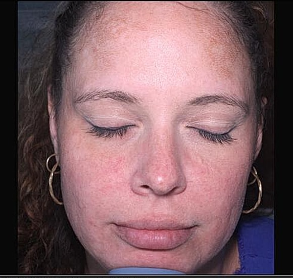 BBL Hero Before & After