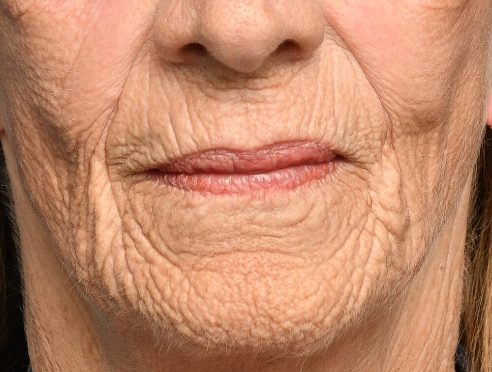 Ablative Laser Before & After