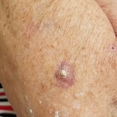 Skin lesion on an elderly person's arm.