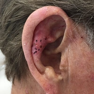 Close-up of a person's ear with skin irritation.