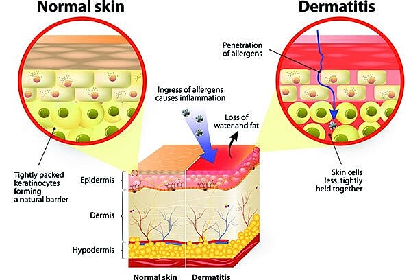Comparison of normal skin and dermatitis characteristics.