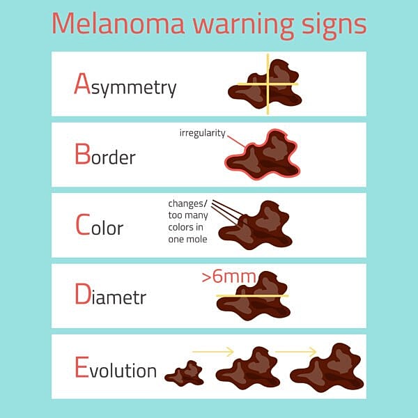 Melanoma warning signs infographic: ABCDE guide