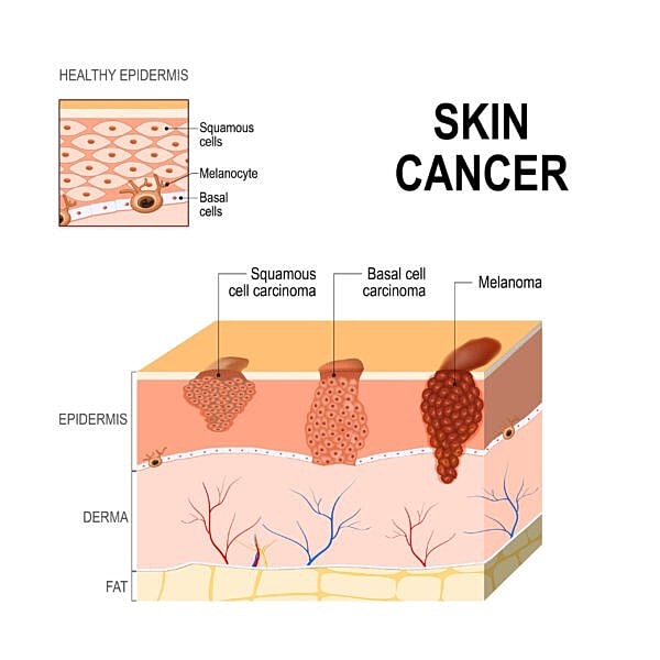 Skin cancer types and healthy skin comparison.