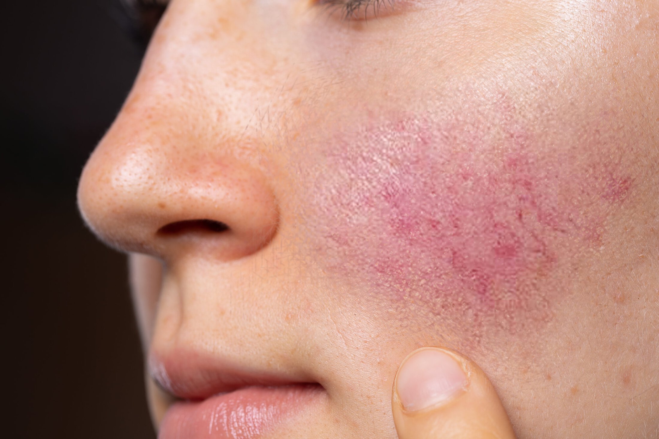 Rosacea Vero Beach Ocean Drive Dermatology in Vero Beach Florida
