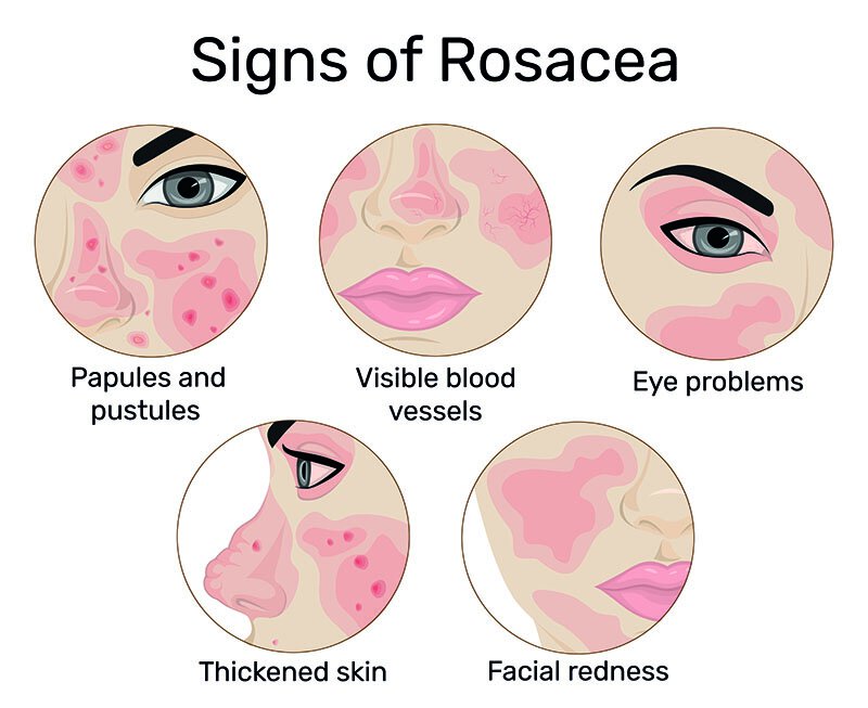 Rosacea Vero Beach Ocean Drive Dermatology in Vero Beach Florida