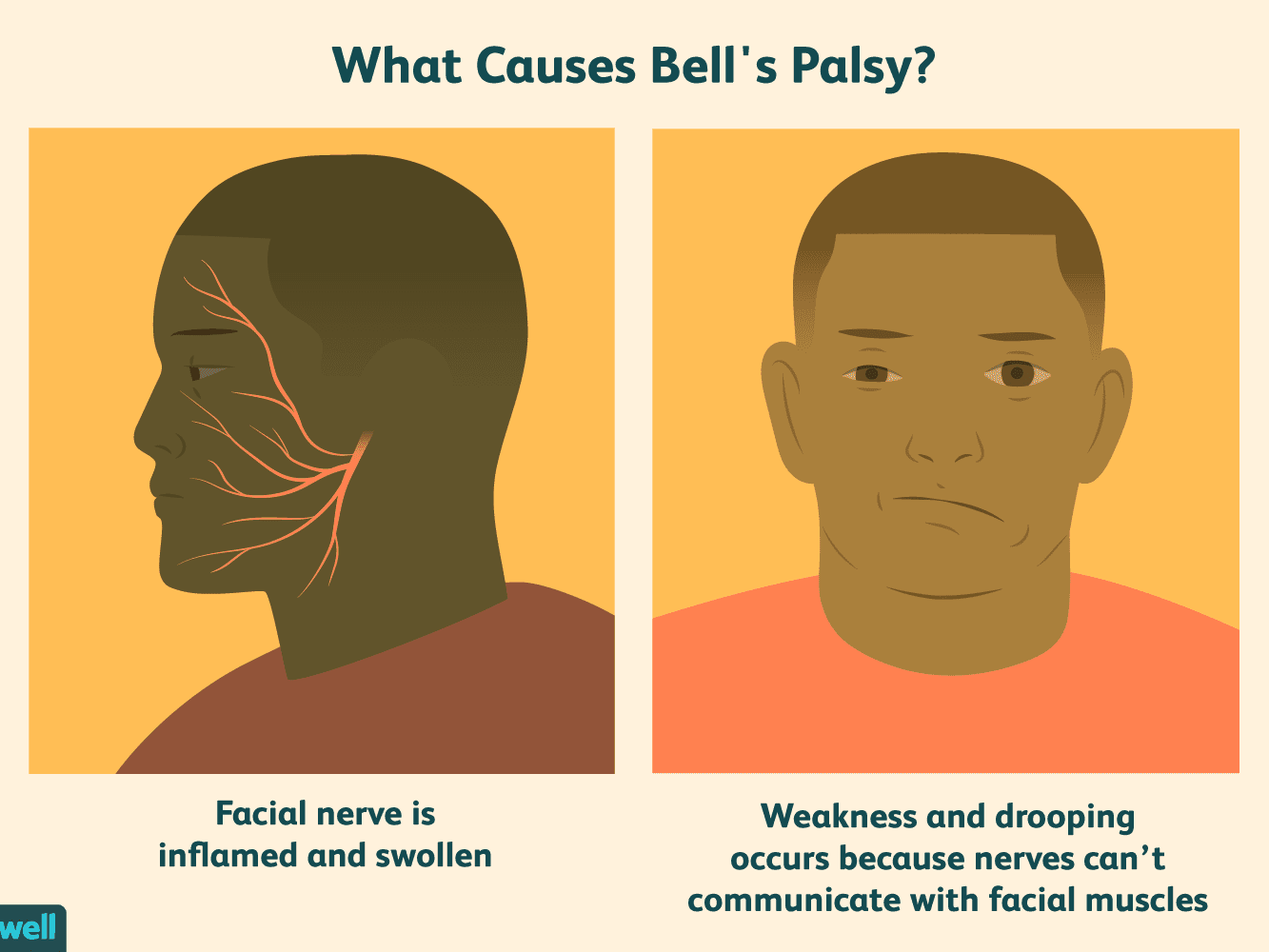 Bell's Palsy Vero Beach Synkinesia Ocean Drive Dermatology