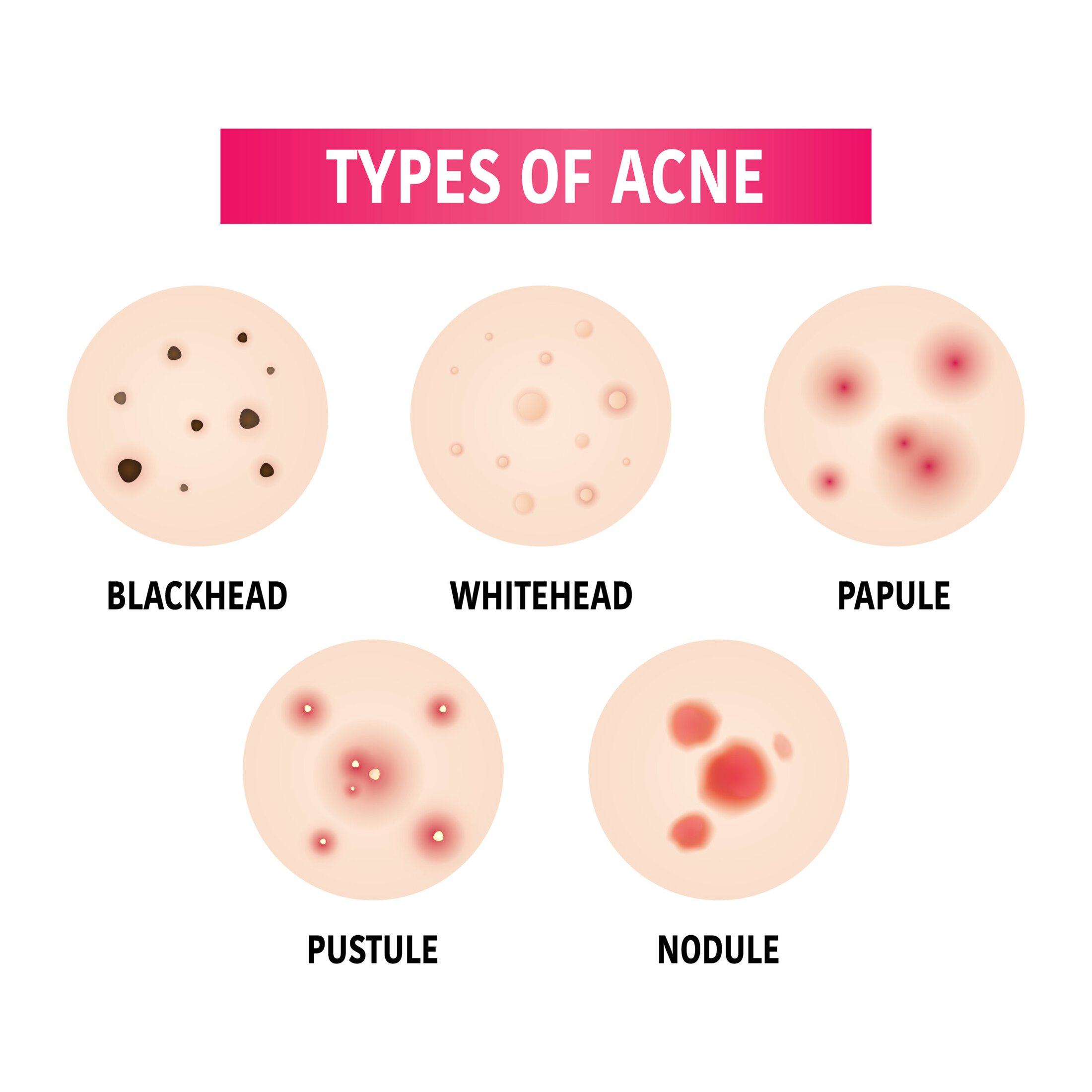 Acne Treatments Vero Beach | Ocean Drive Dermatology