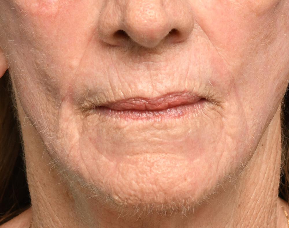 Ablative Laser Before & After Image