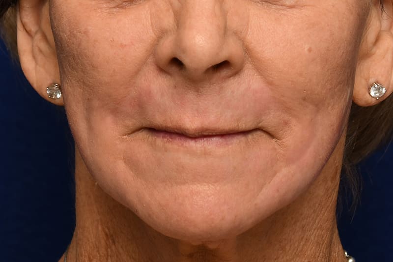 Ablative Laser Before & After Image