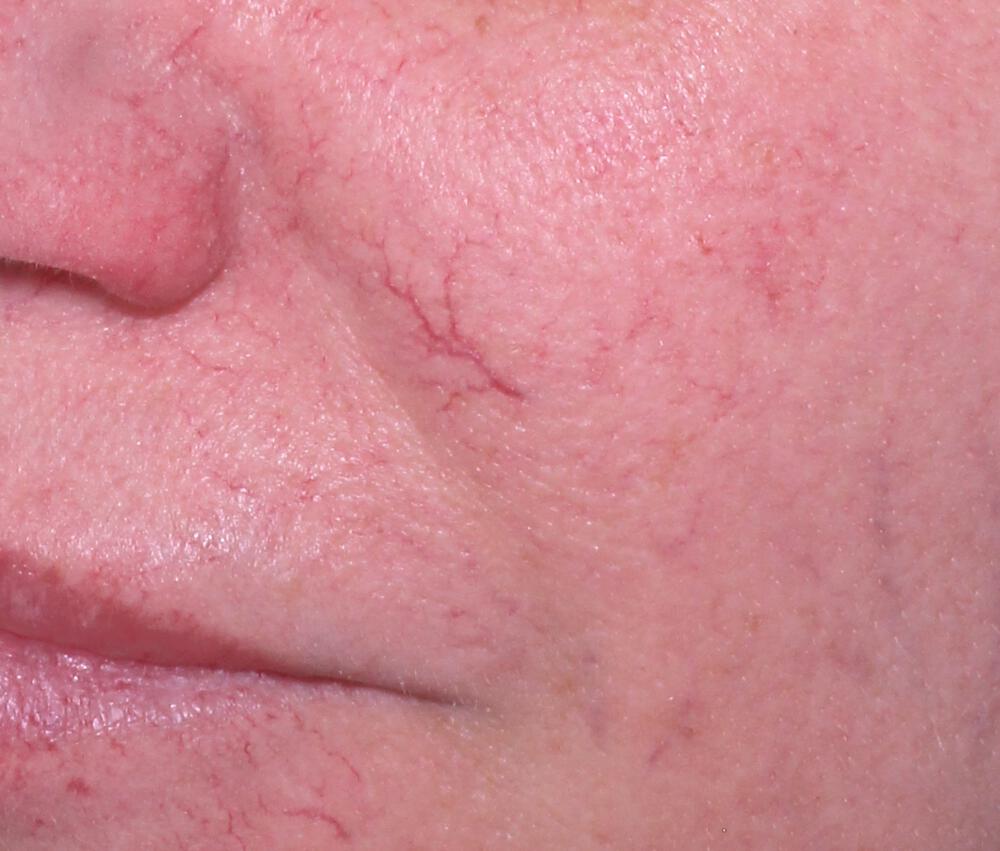 Clear V Laser Before & After Image