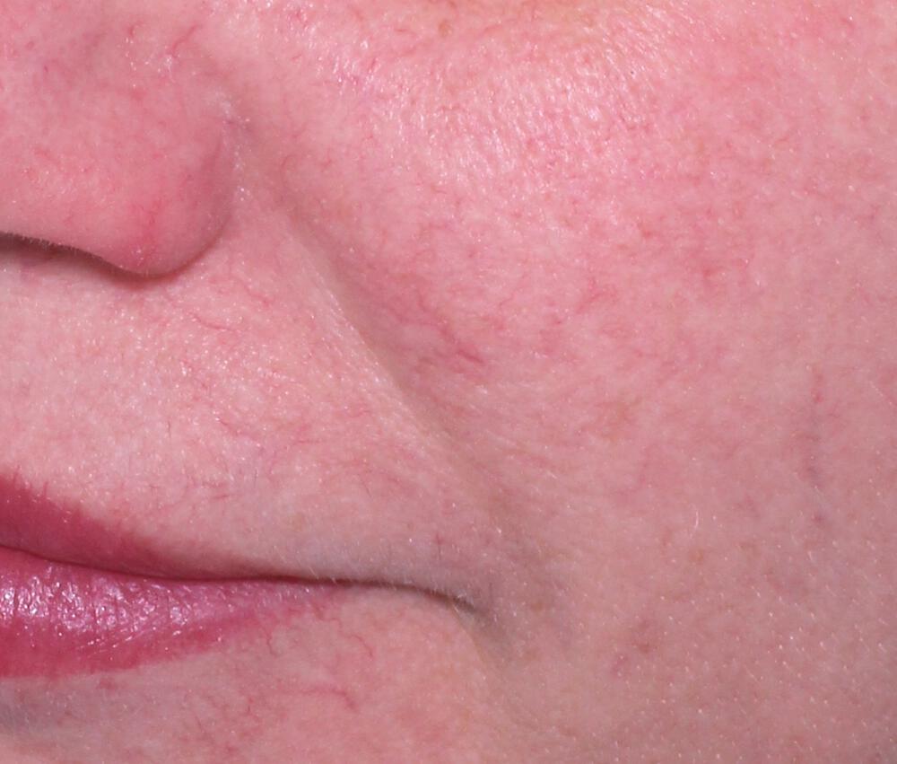 Clear V Laser Before & After Image