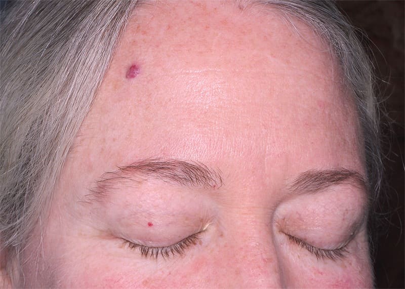 Clear V Laser Before & After Image