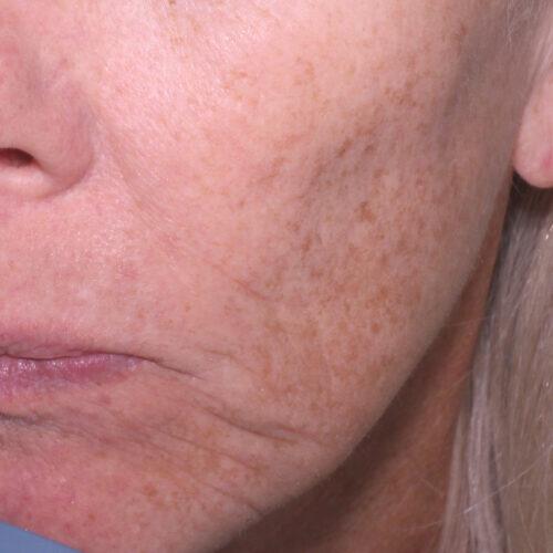 Halo Hybrid Fractional Laser Before & After Image