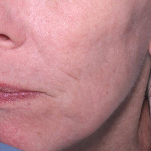 Halo Hybrid Fractional Laser Before & After Image