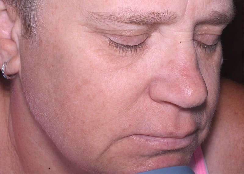 Halo Hybrid Fractional Laser Before & After Image