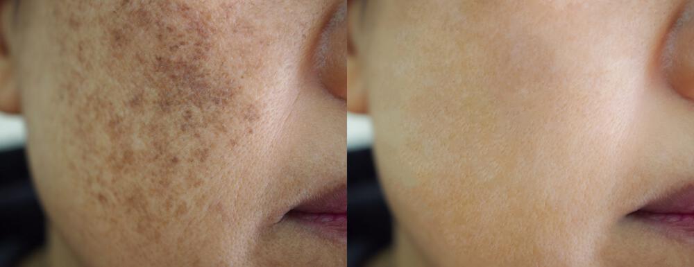 Melasma Treatment Before & After Image