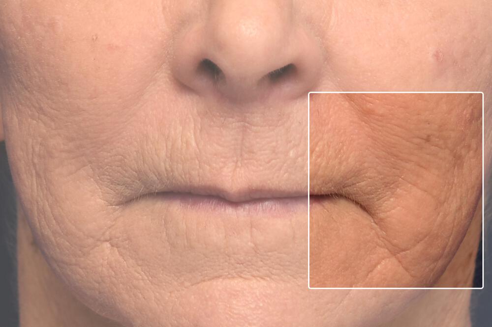 ProFractional Laser Before & After Image